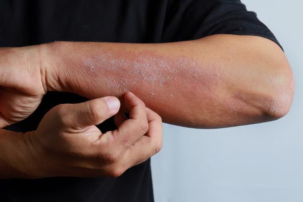 Man itching rash on arm